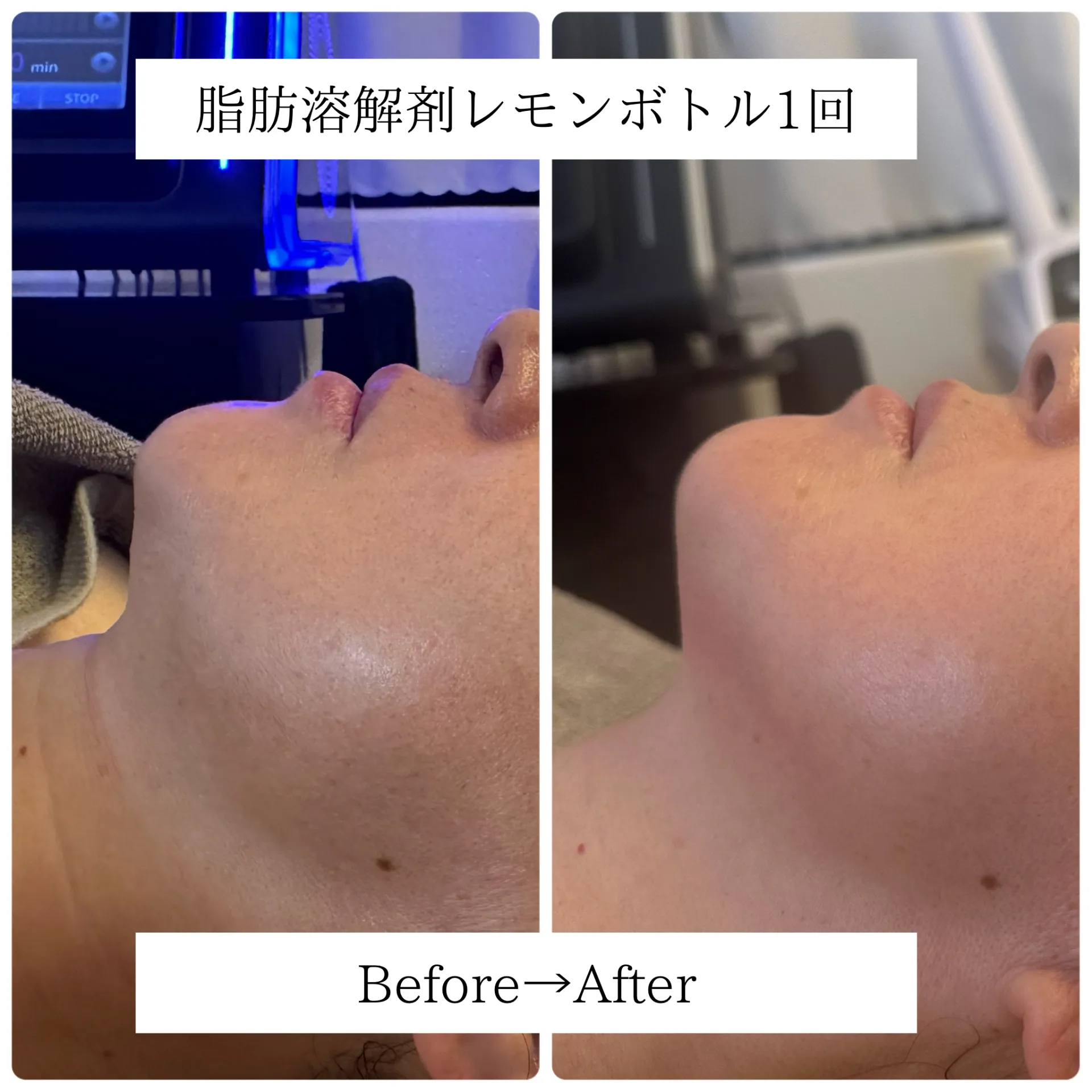 レモンボトル1回 あご下