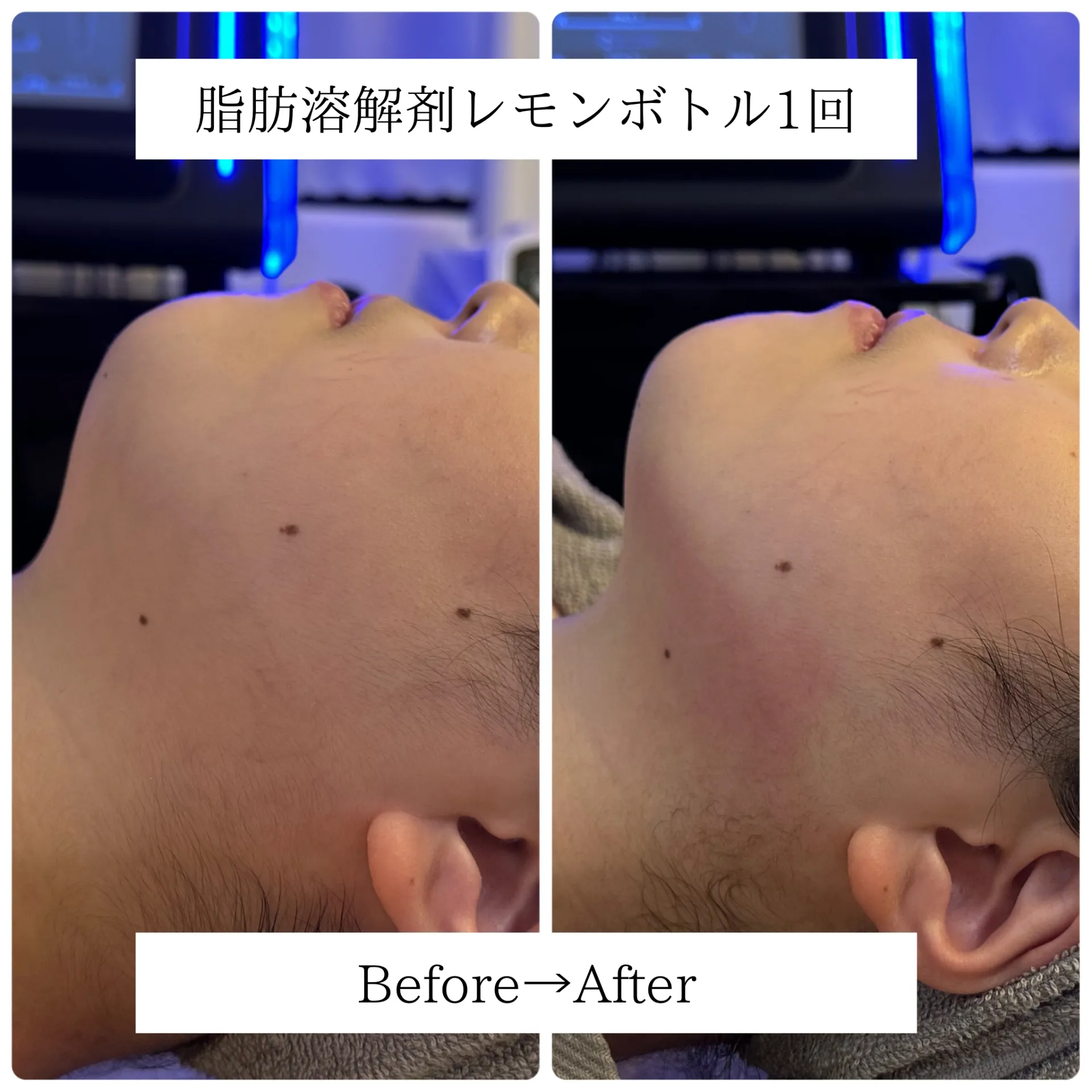 レモンボトル1回